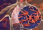 TUBERCULOSIS: ALERTA POR EL AUMENTO DE CASOS EN ARGENTINA